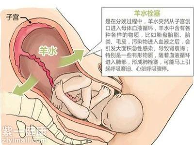 孕妇怎样避免羊水栓塞 五种方法提前避免